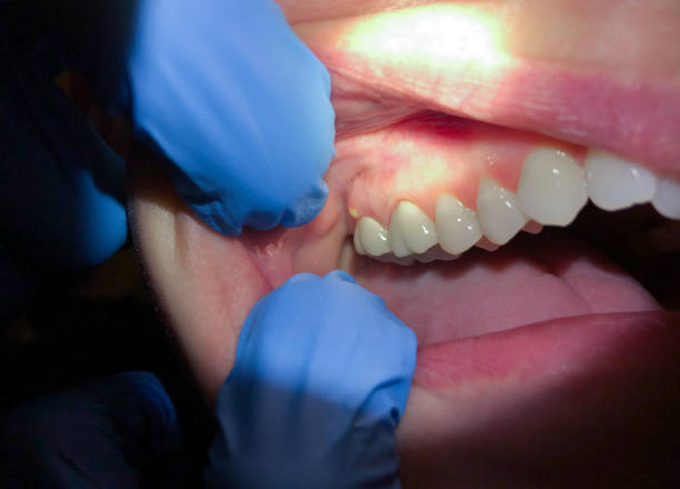 Best Emergency Wisdom Teeth Removal in Metamora, IL