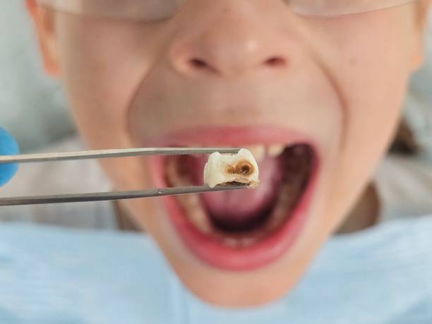 Best Emergency Dental Care for Broken or Chipped Teeth in Metamora, IL